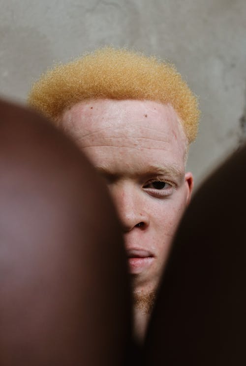 Portrait of Albino Man from Cameroon