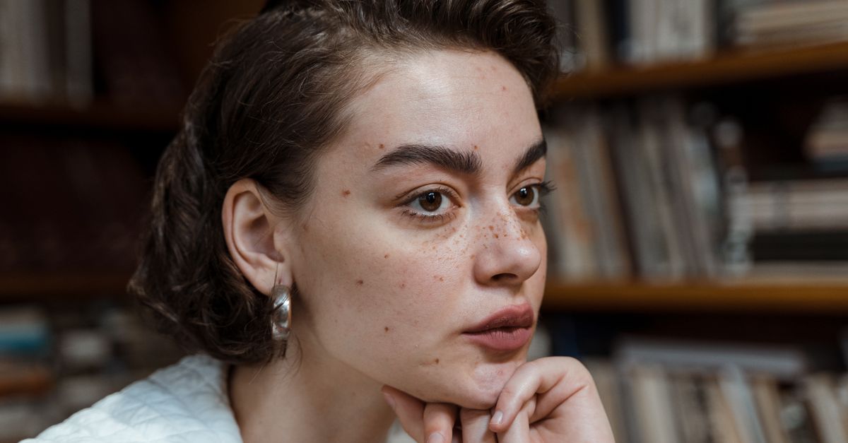 How Can You Prevent Acne Naturally