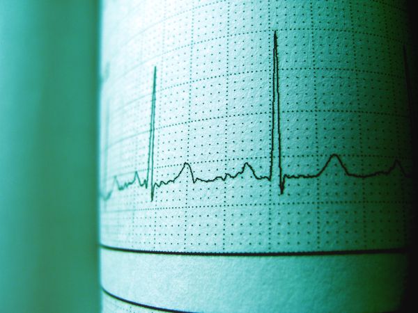 Pacemaker Implantation