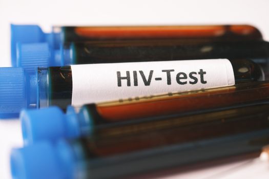 A detailed close-up image showing blood samples labeled for HIV testing.
