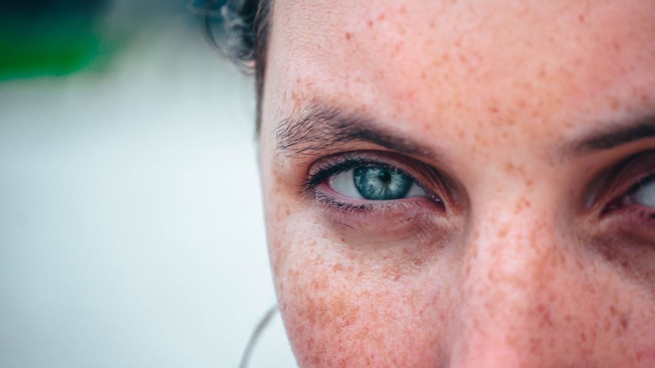 Blefaroplastia sem Cortes em Jaú: Transformação Antes e Depois com Jato de Plasma - Augusta Perfection