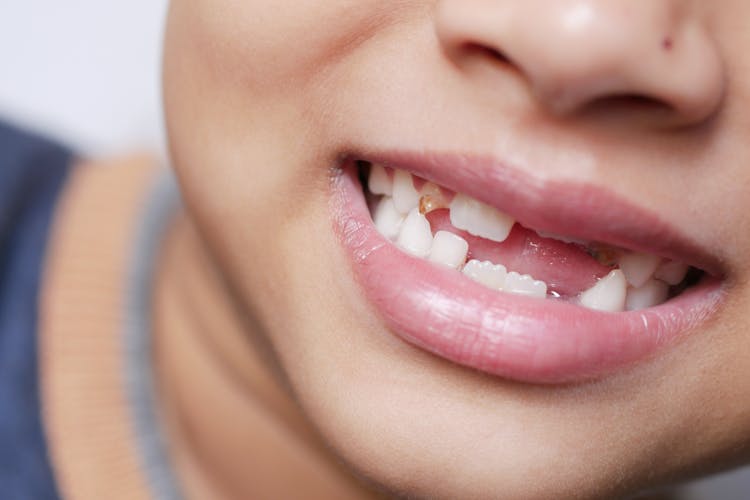 Close-Up Shot Of A Kid With Missing Tooth 