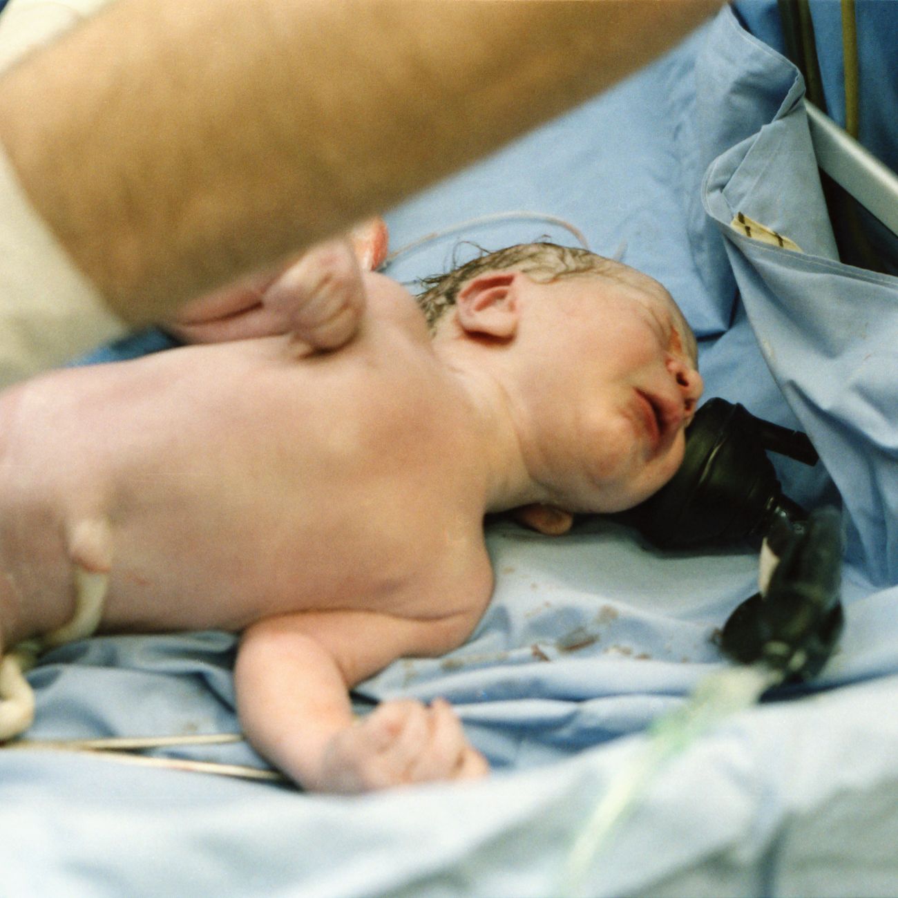 'ECURLINE UMBILICAL CORD CLAMP #3500