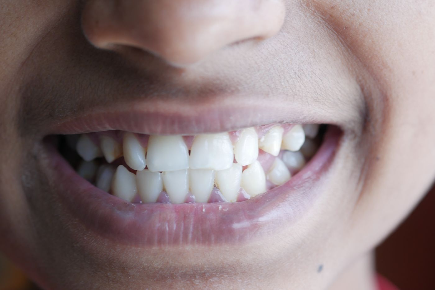 Patient showing confident smile after whitening