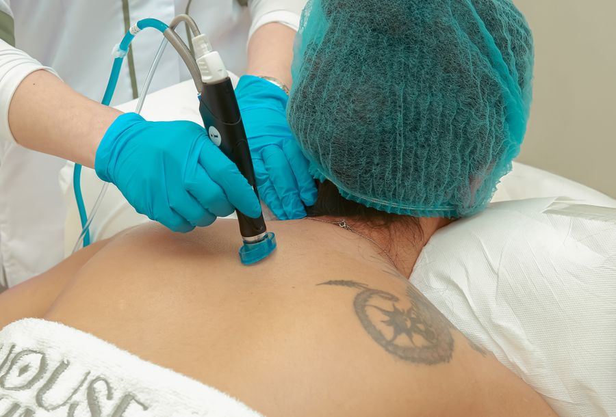 Laser treatment