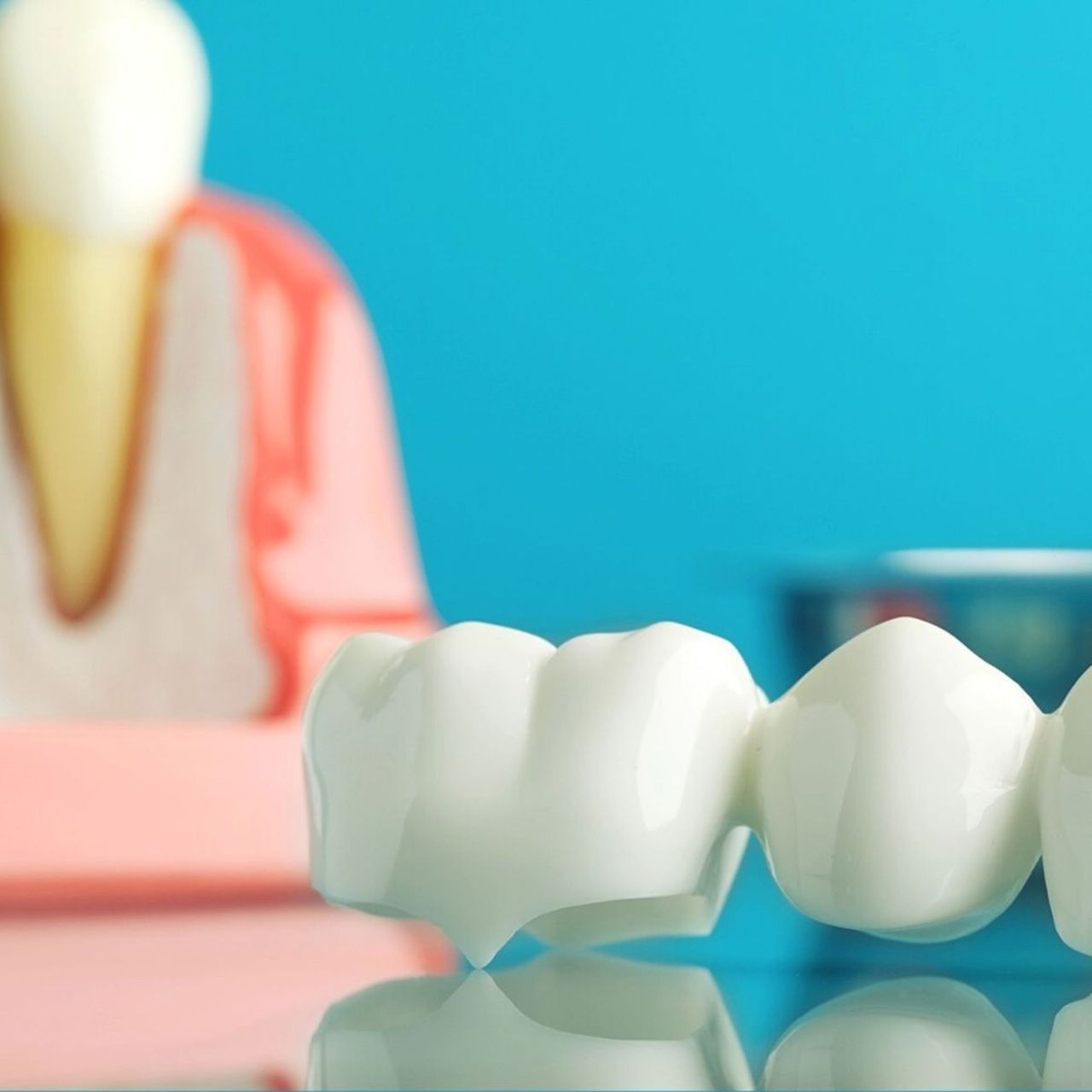Close-up of a dental crown prosthetic with tooth model