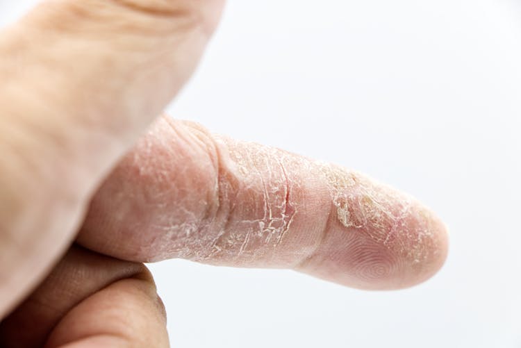 Close-up Of Dry Skin On A Finger 