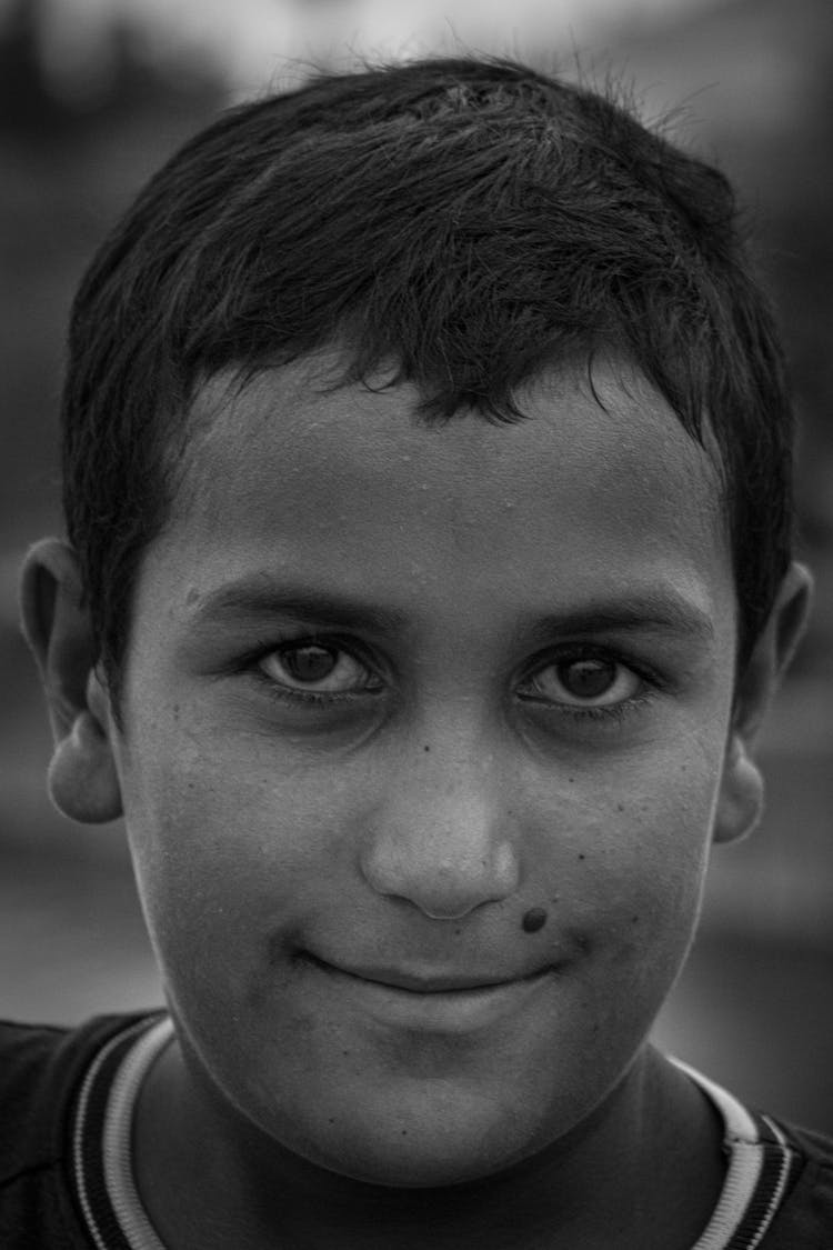 Grayscale Photo Of Boy With Mole On The Face