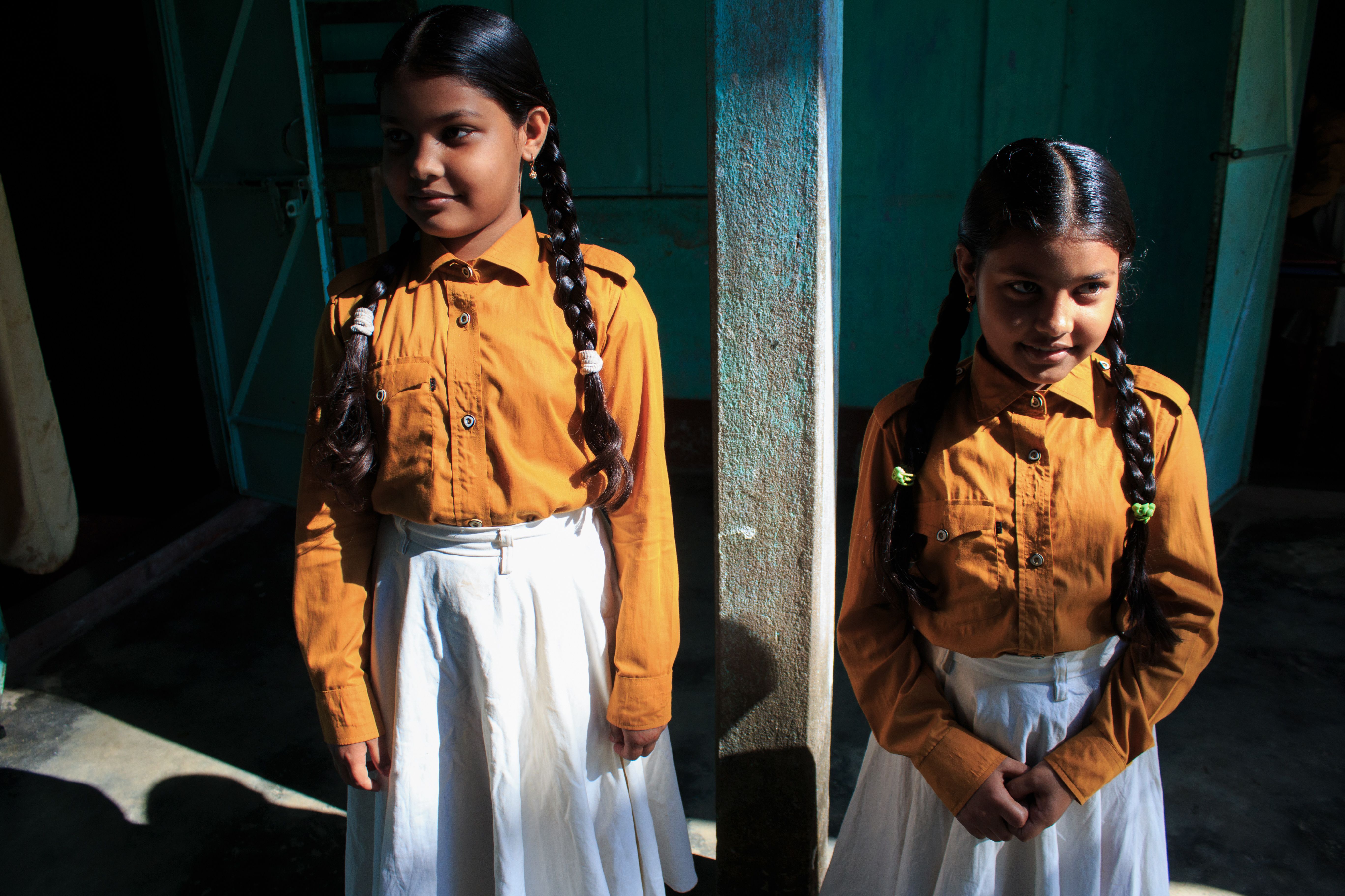 Photos Conjoined Twins