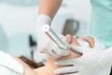 Microneedling treatment