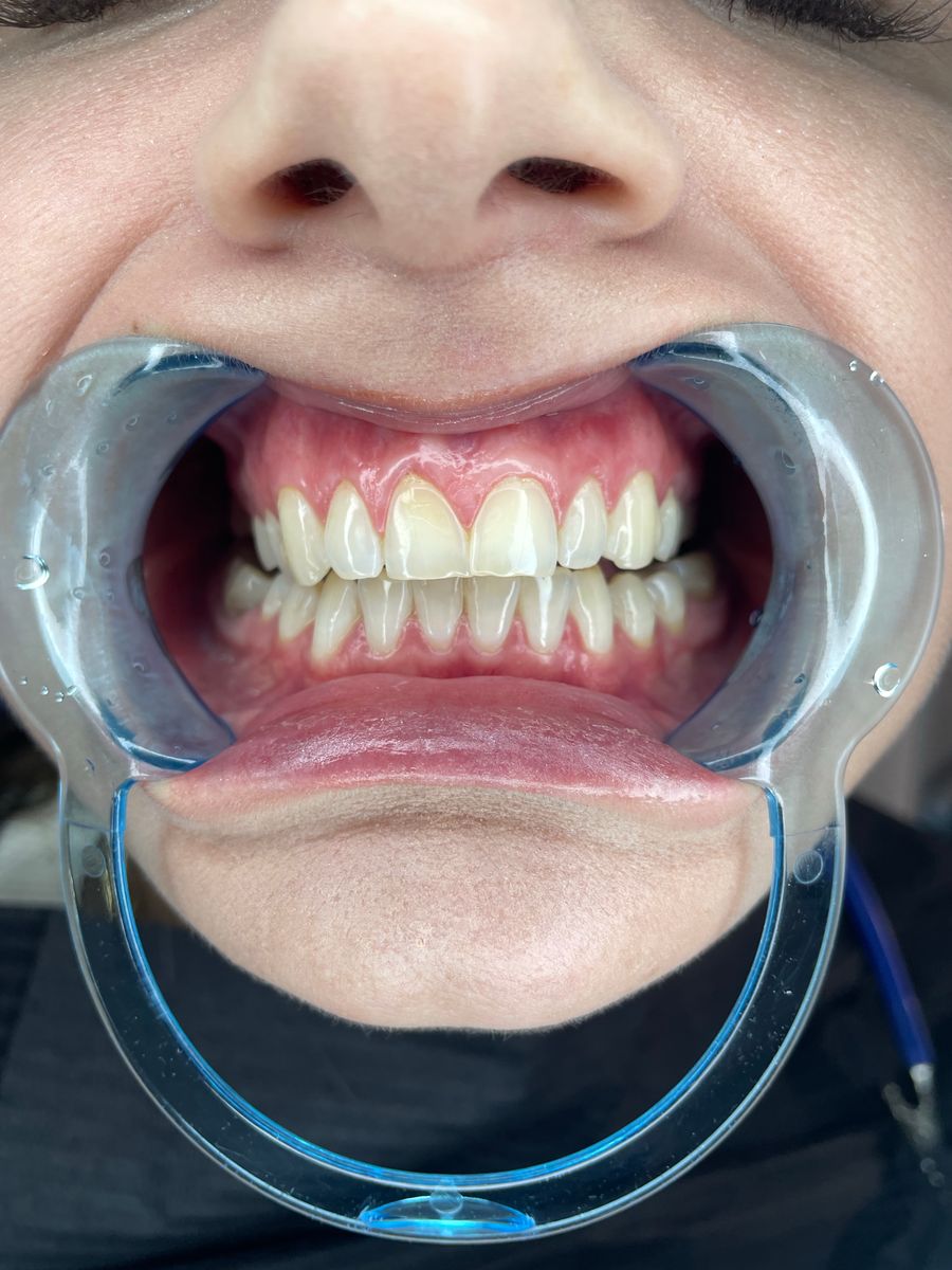 Intraoral dental photo showing teeth in a cheek retractor (illustrative before example)