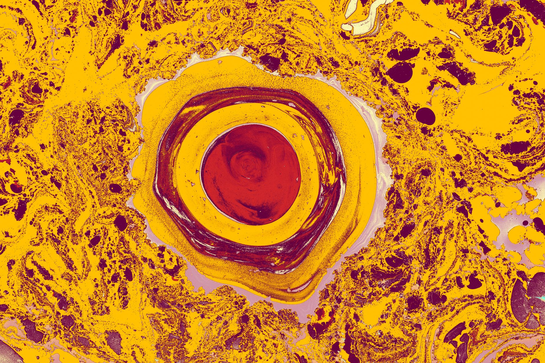 Parotid Gland Tumors: Understanding the Lump in Your Cheek