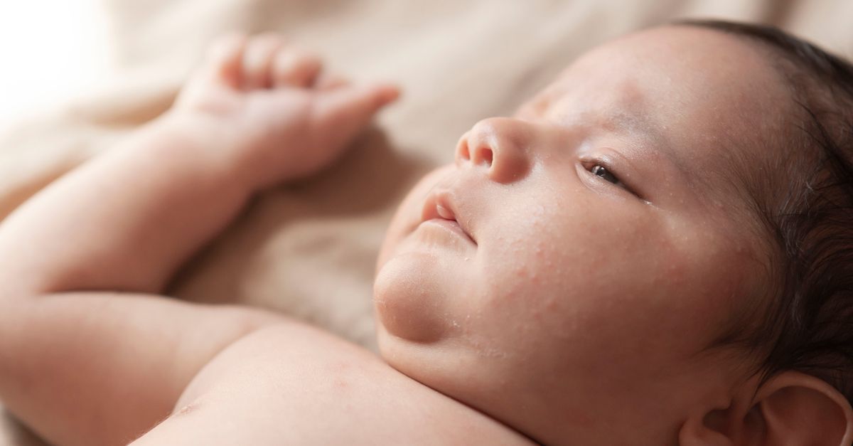 CDC Director Disputes Pennsylvania's Measles Death Reports