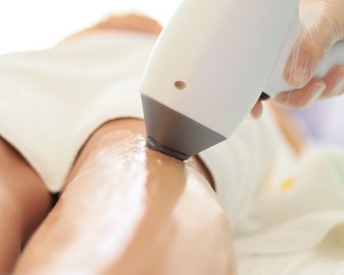 Laser hair removal on legs