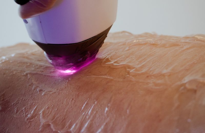 Tattoo Removal Treatment at Derma Skin and Hair Solutions