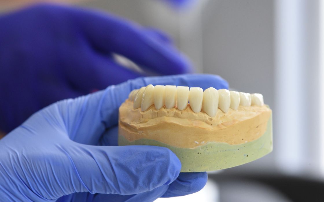 Close-up of a dental model held by gloved hands in a laboratory setting.