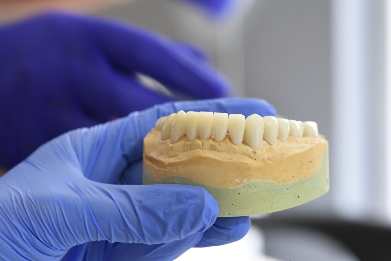 Dental jaw model showing teeth arrangement for bridge placement
