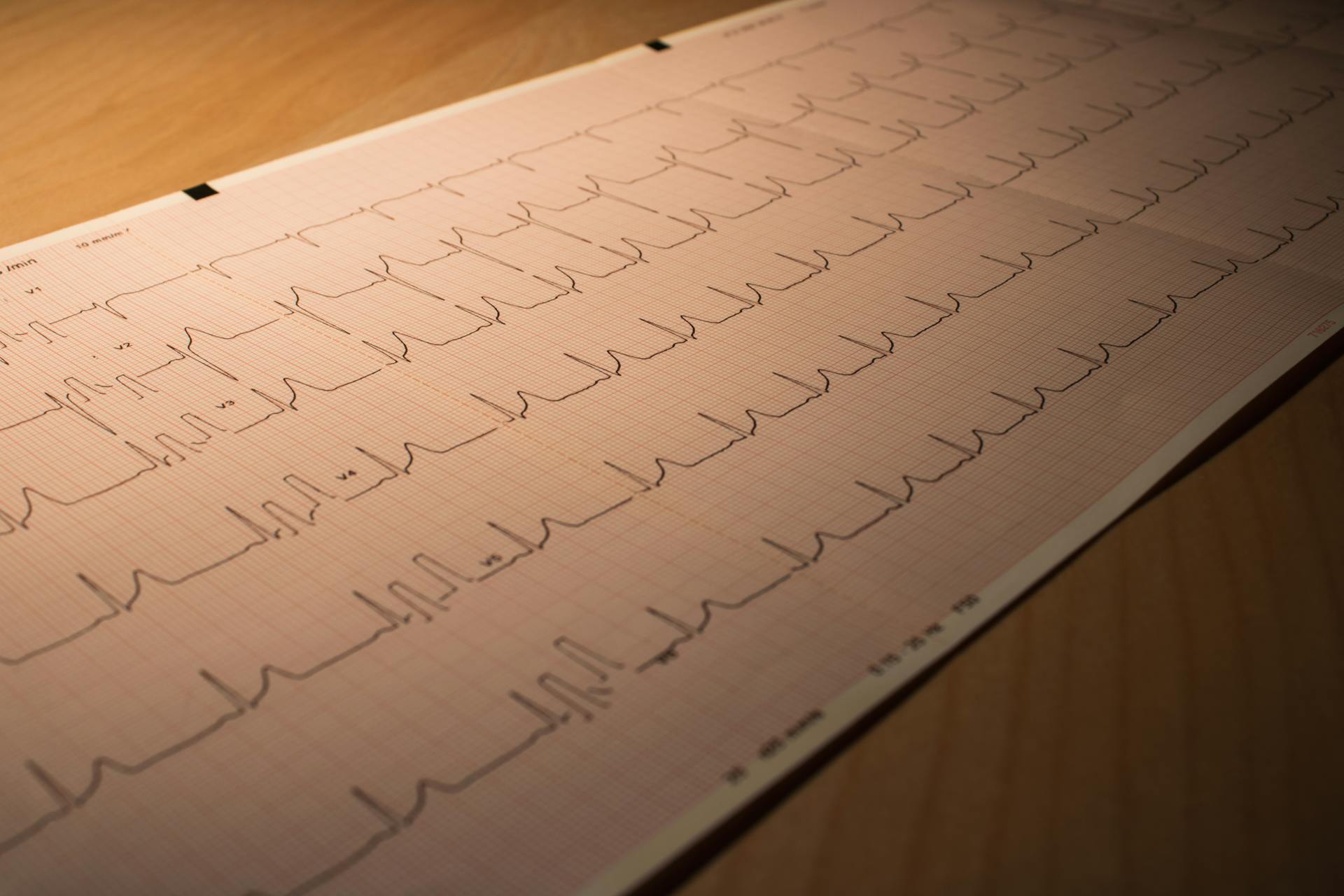 Une feuille d'ECG sur une table avec un moniteur cardiaque