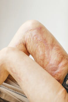 Detailed close-up of burn scars on a woman's legs, highlighting skin texture and healing.