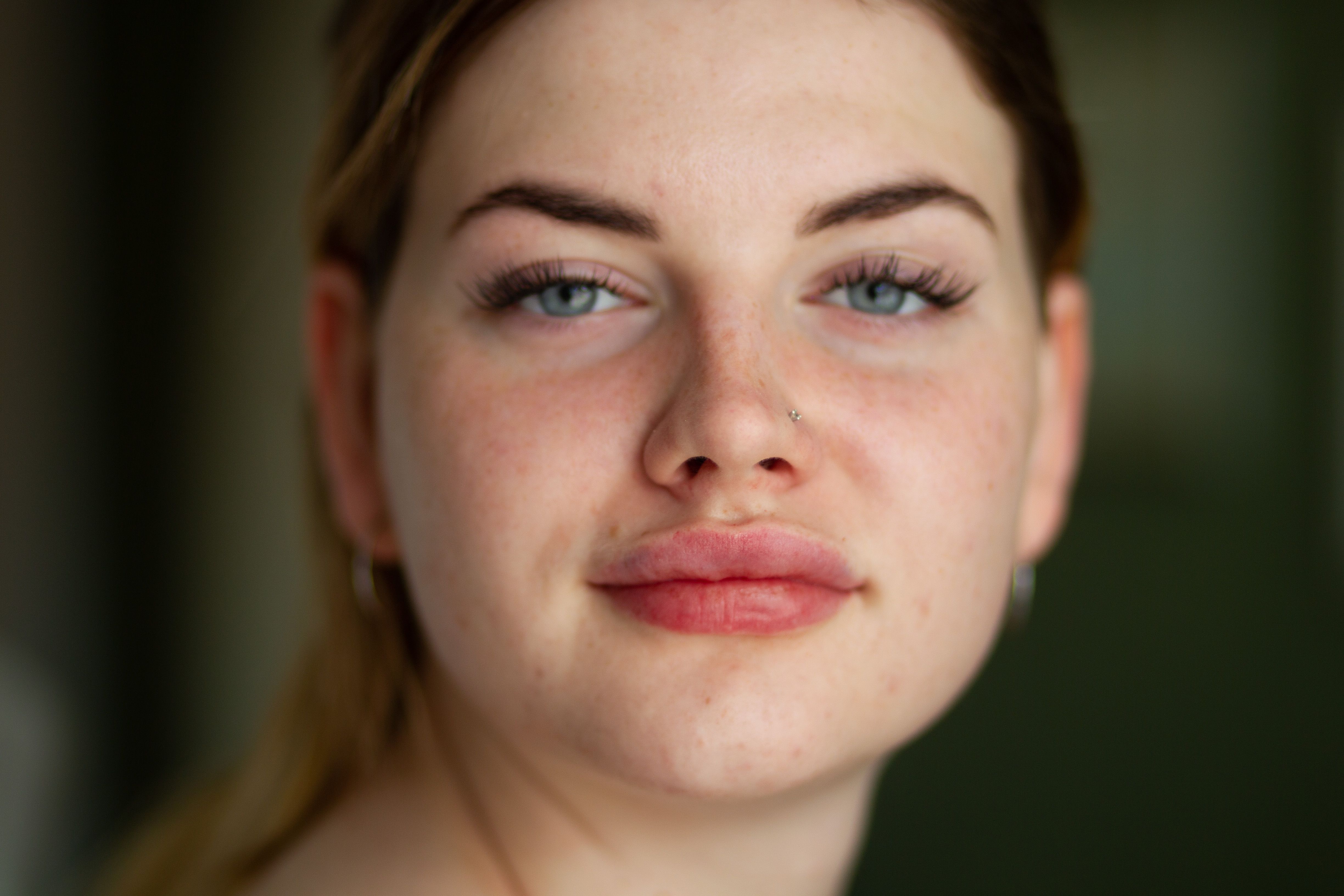 Lip Augmentation Results - dermal fillers san antonio