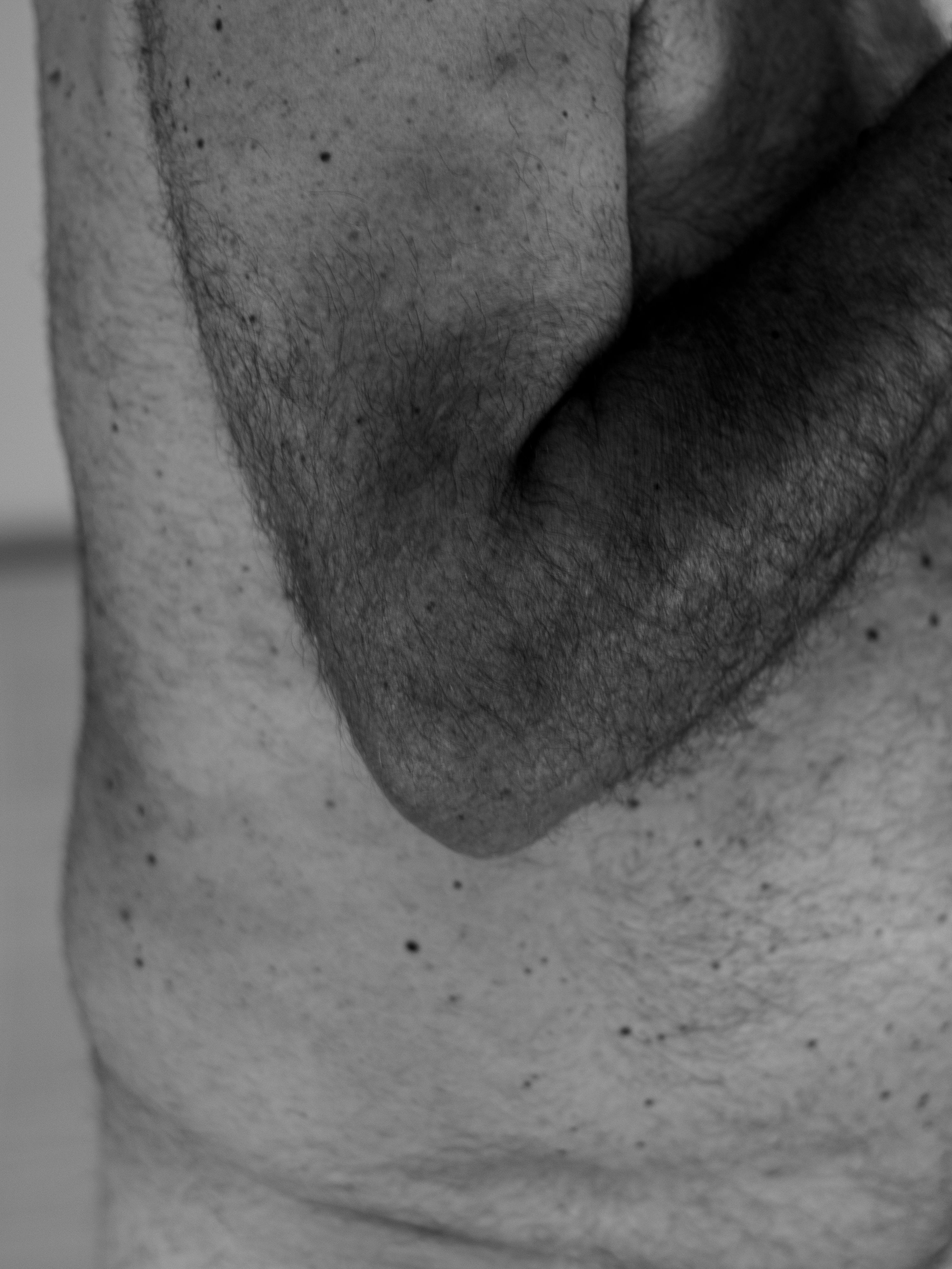 Pseudosarcomatous Fibromatosis (ICD-10: M72.4) - Pemahaman Lengkap