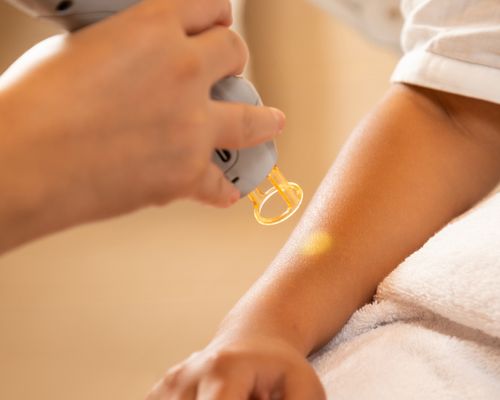 Laser hair removal on arms