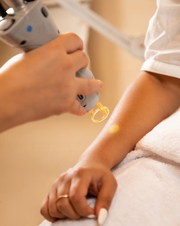 tattoo laser removal