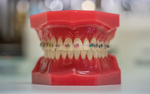 Dental model fitted with orthodontic braces at Smile Point Tollygunge Kolkata