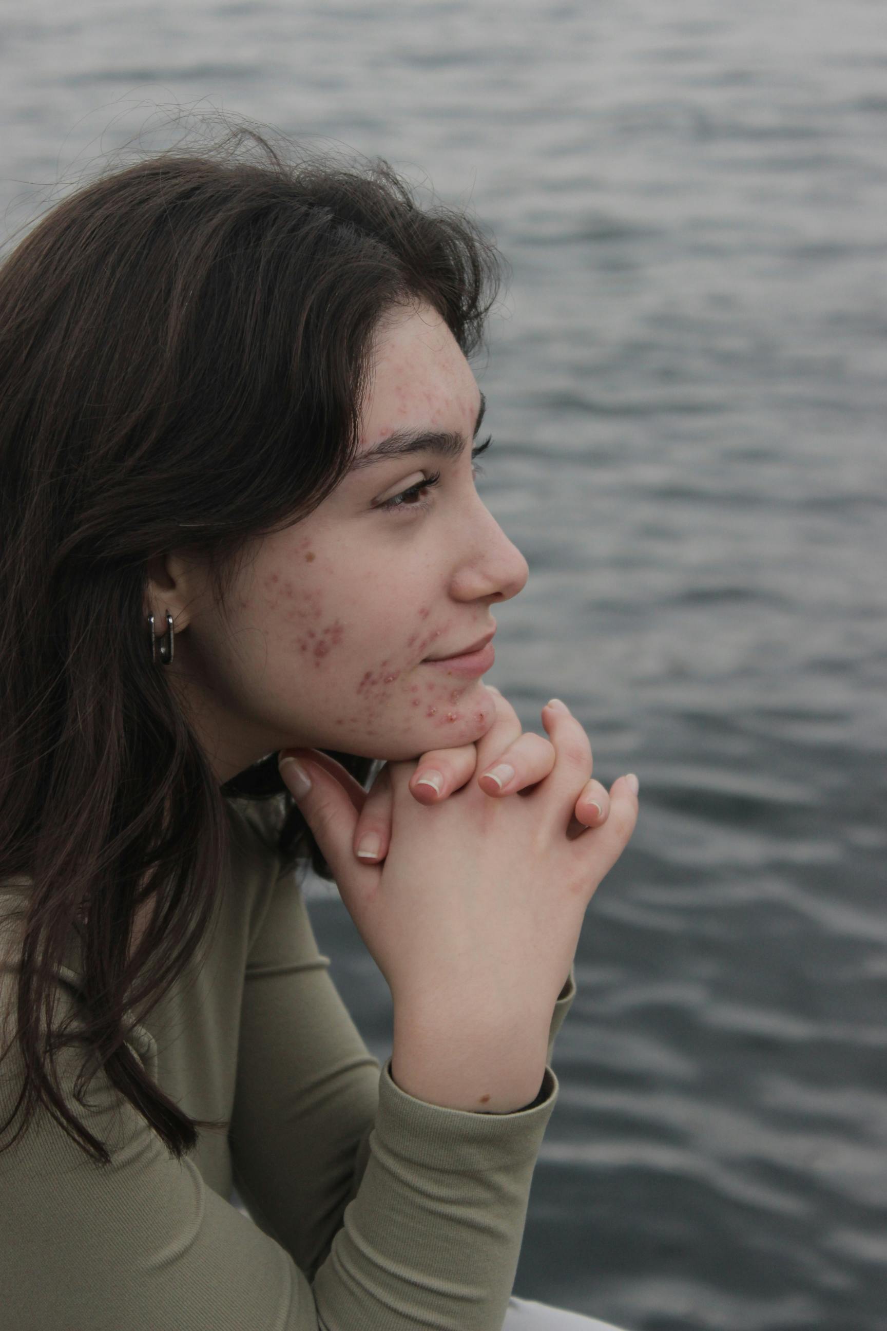 Profile of a young woman with acne relaxing by the water in Istanbul, Türkiye.