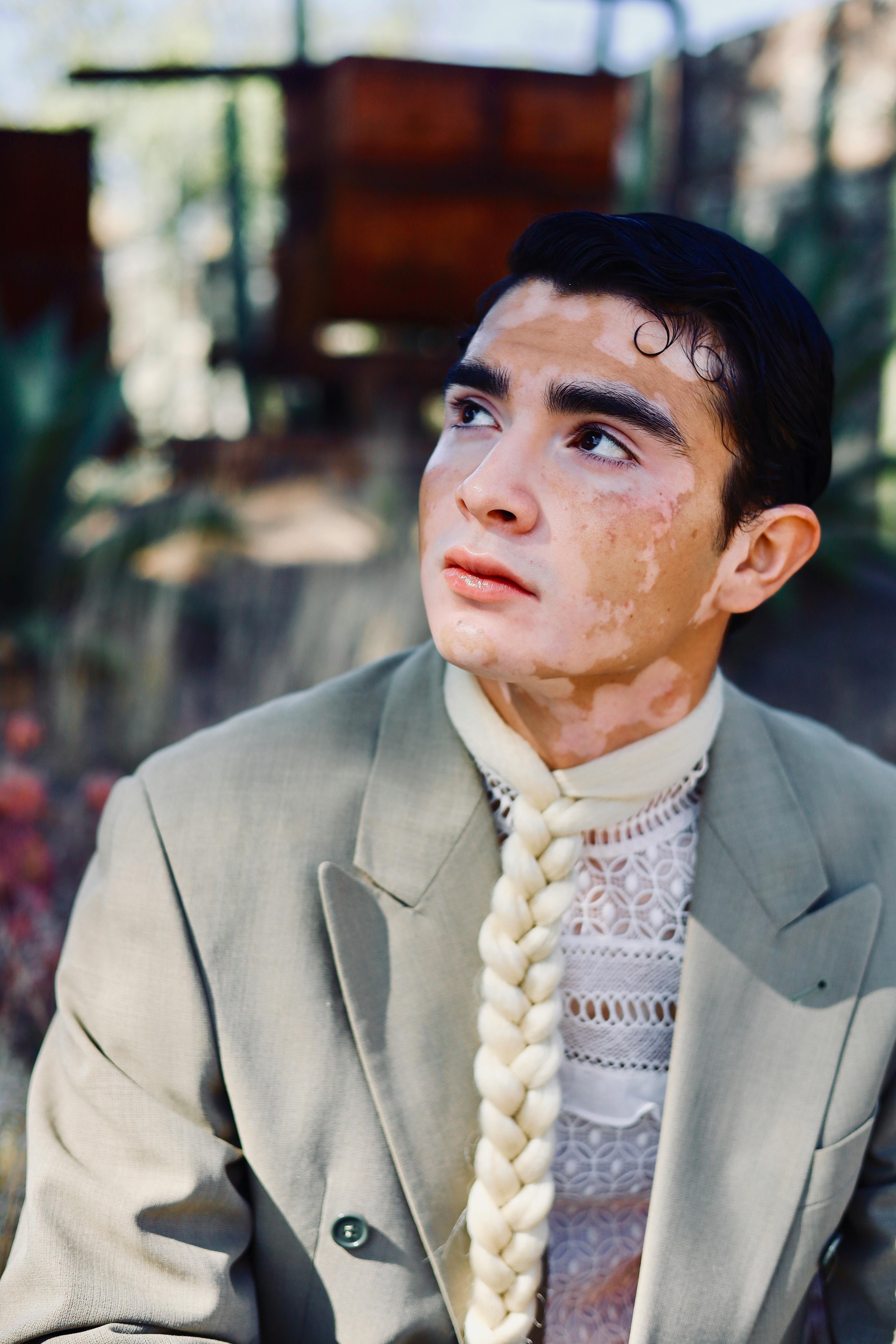 Portrait of a young man with vitiligo looking up, wearing a braided hairstyle and elegant attire outdoors.