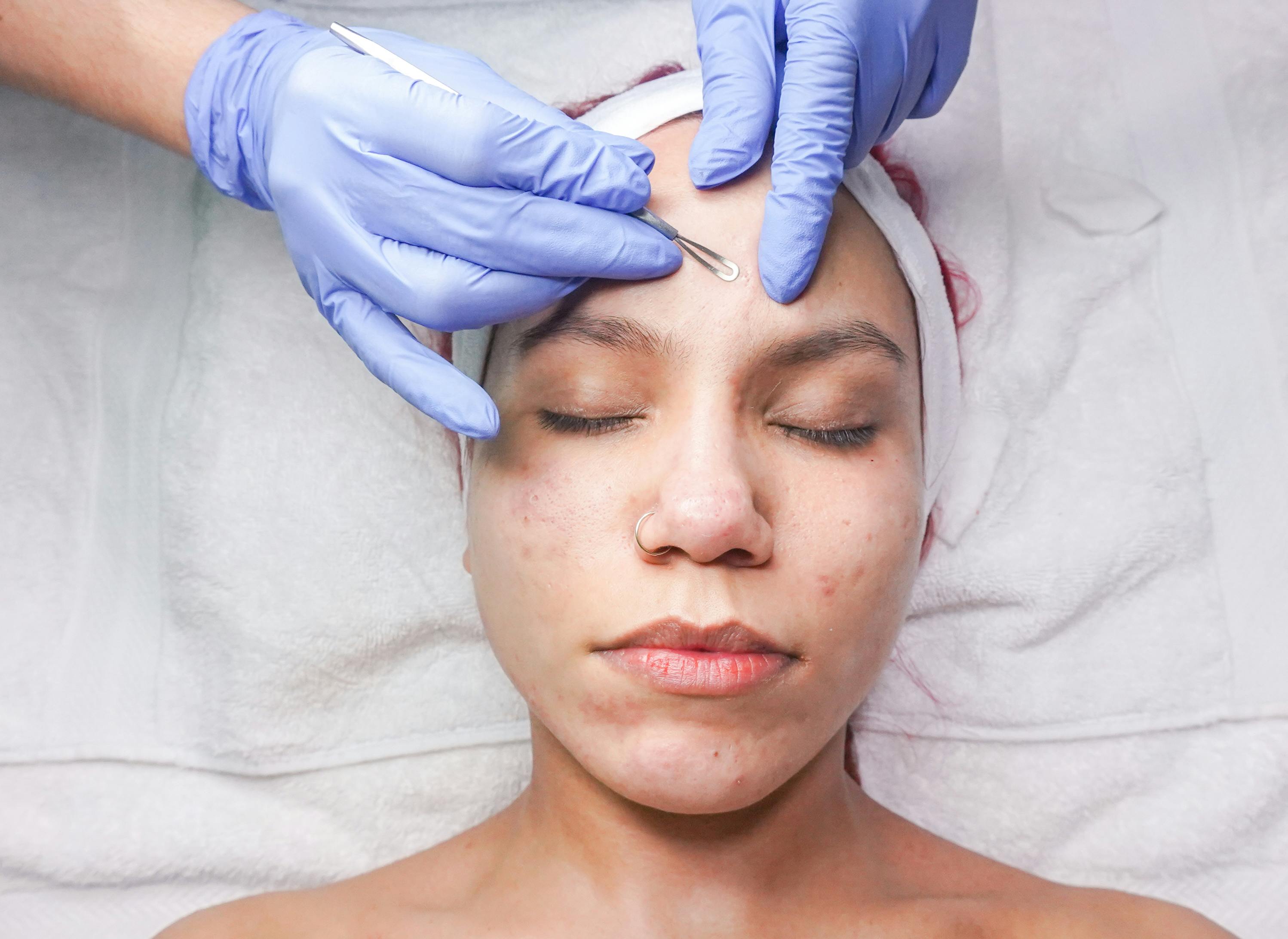 pimple-face-hd-photos-download-the-best-free-pimple-face-hd-stock