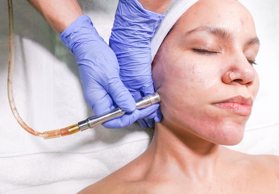 Before — Even-toned, clarified complexion