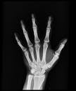 Hand X-ray Result