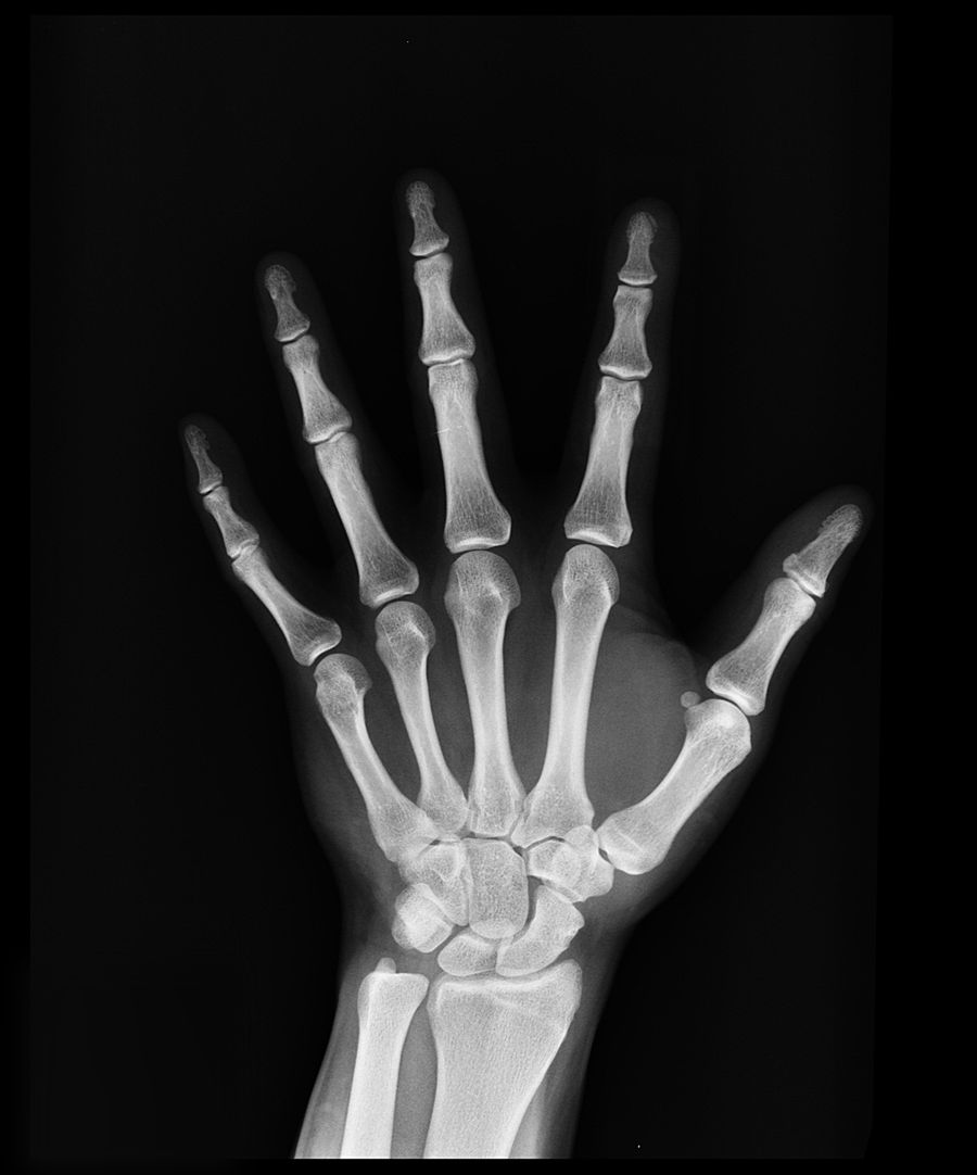 X-ray showing bone anatomy relevant to interlocking nail fixation