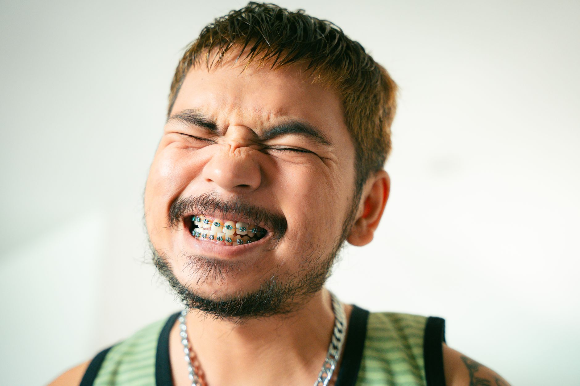 Molar Bands: Your Orthodontist's Secret Weapon for a Perfect Smile