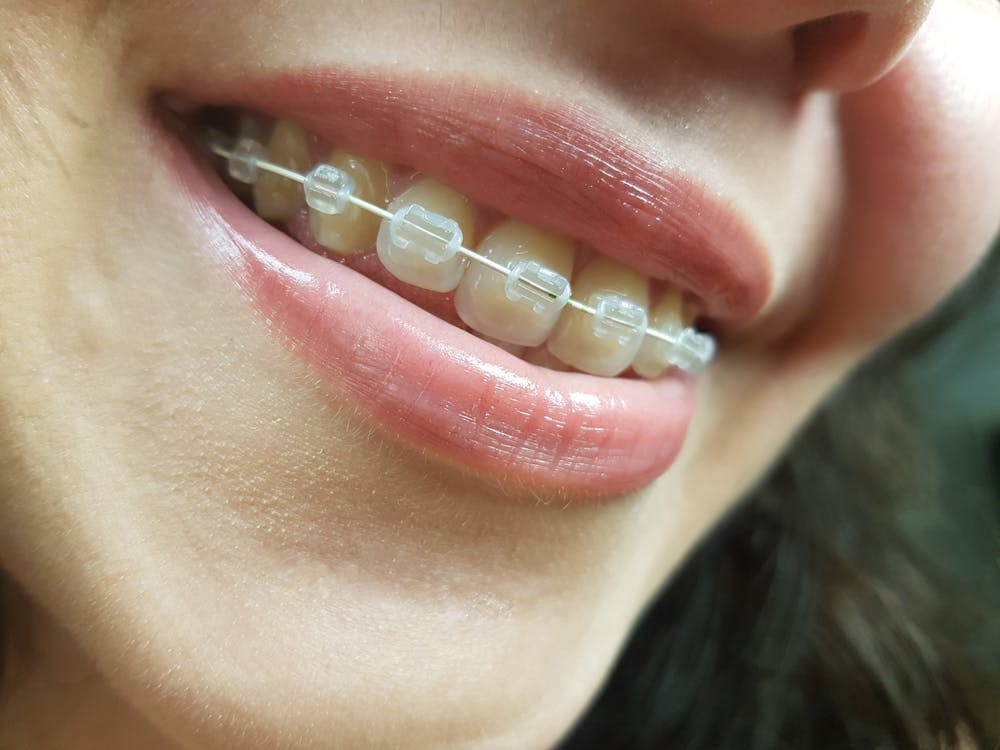 Free stock photo of braces, brackets, close-up