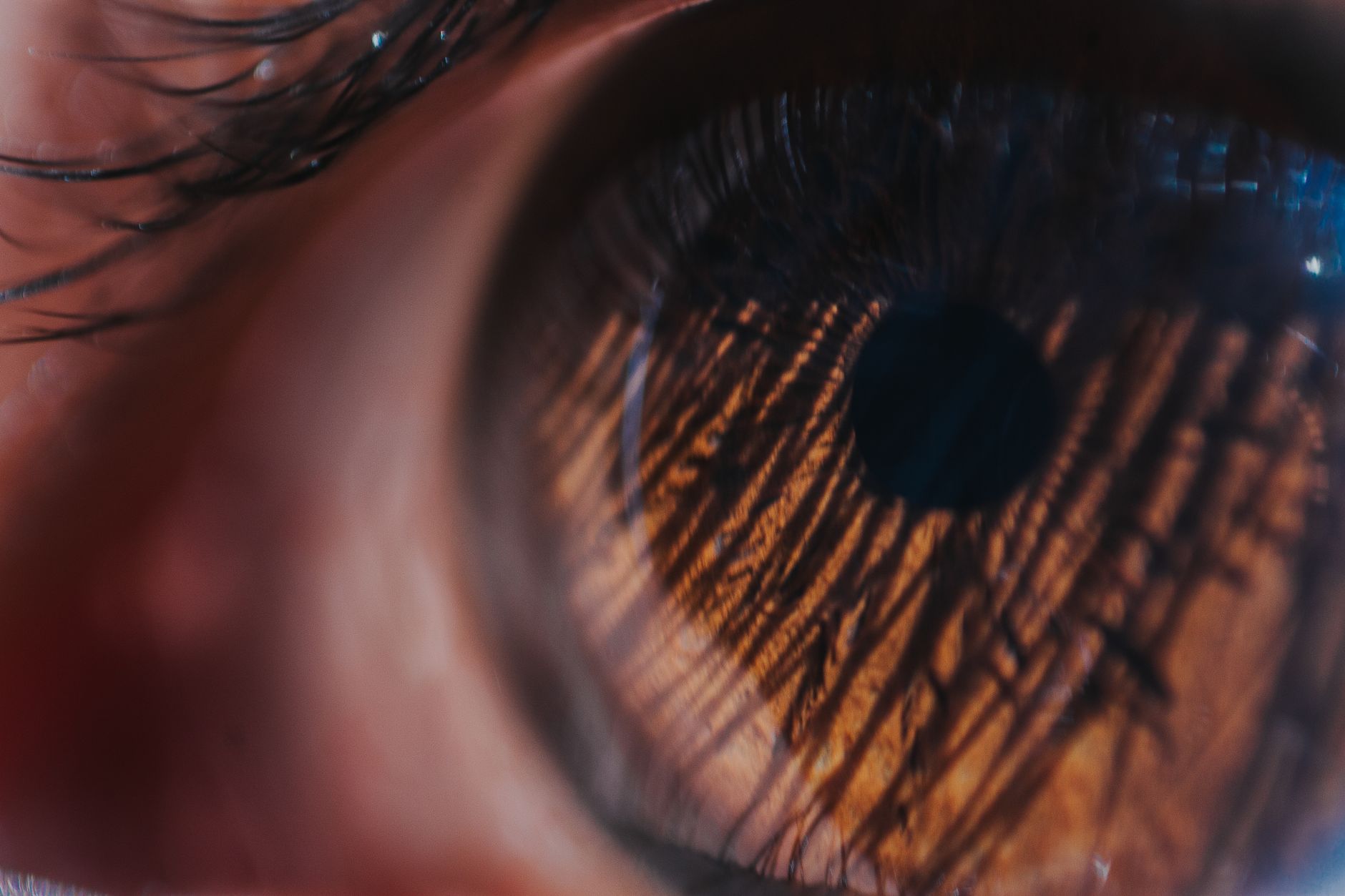 Wet Age-Related Macular Degeneration (AMD): Understanding Treatments and Outlook