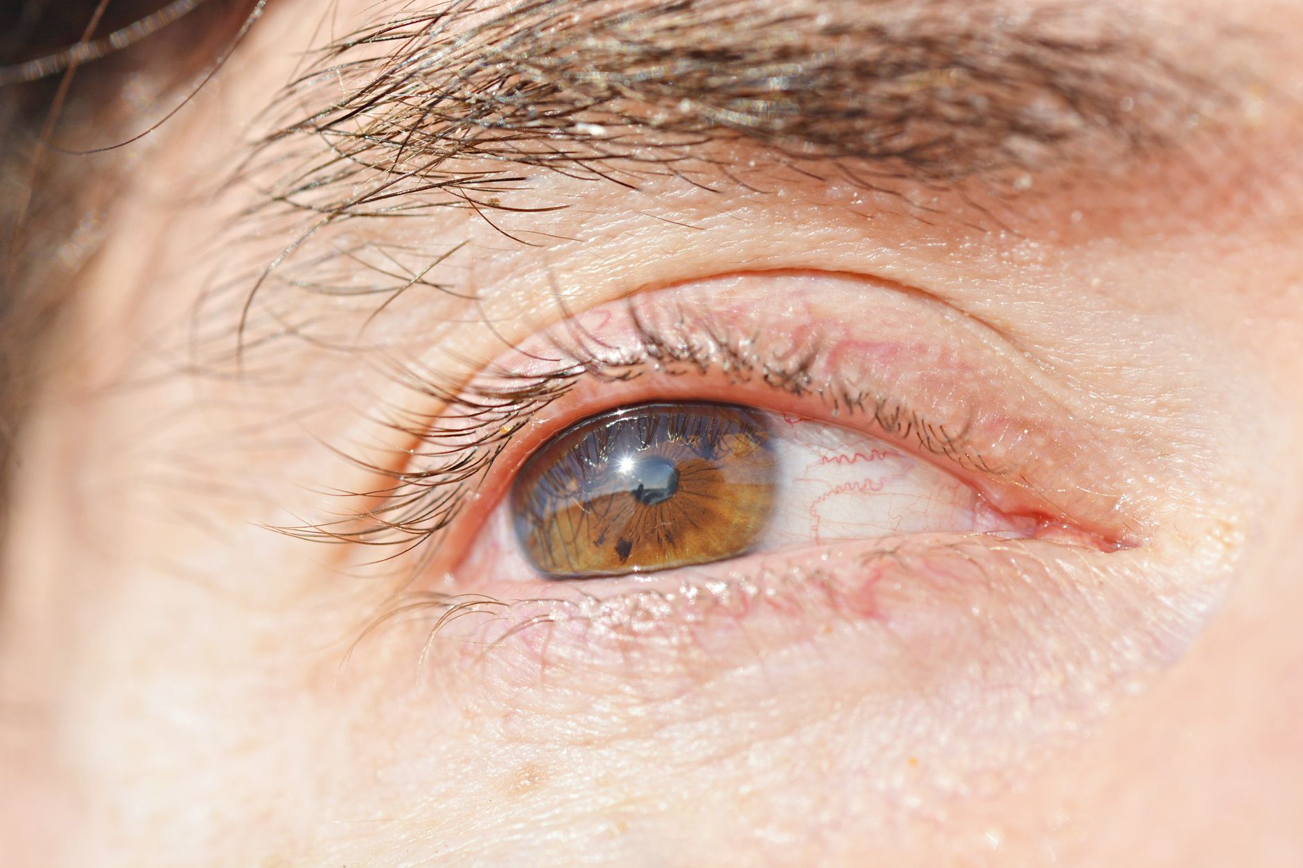 Veiny Eyelids: Understanding the Causes and Treatment Options