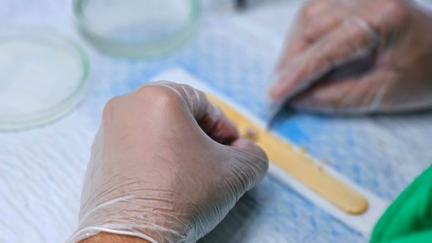 Detailed view of hair graft preparation during a hair transplant surgery.