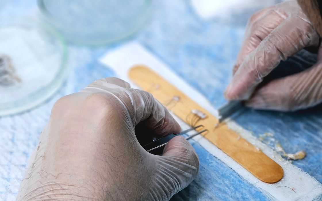 Close-up of surgeons preparing hair grafts for transplantation, demonstrating precise skills.
