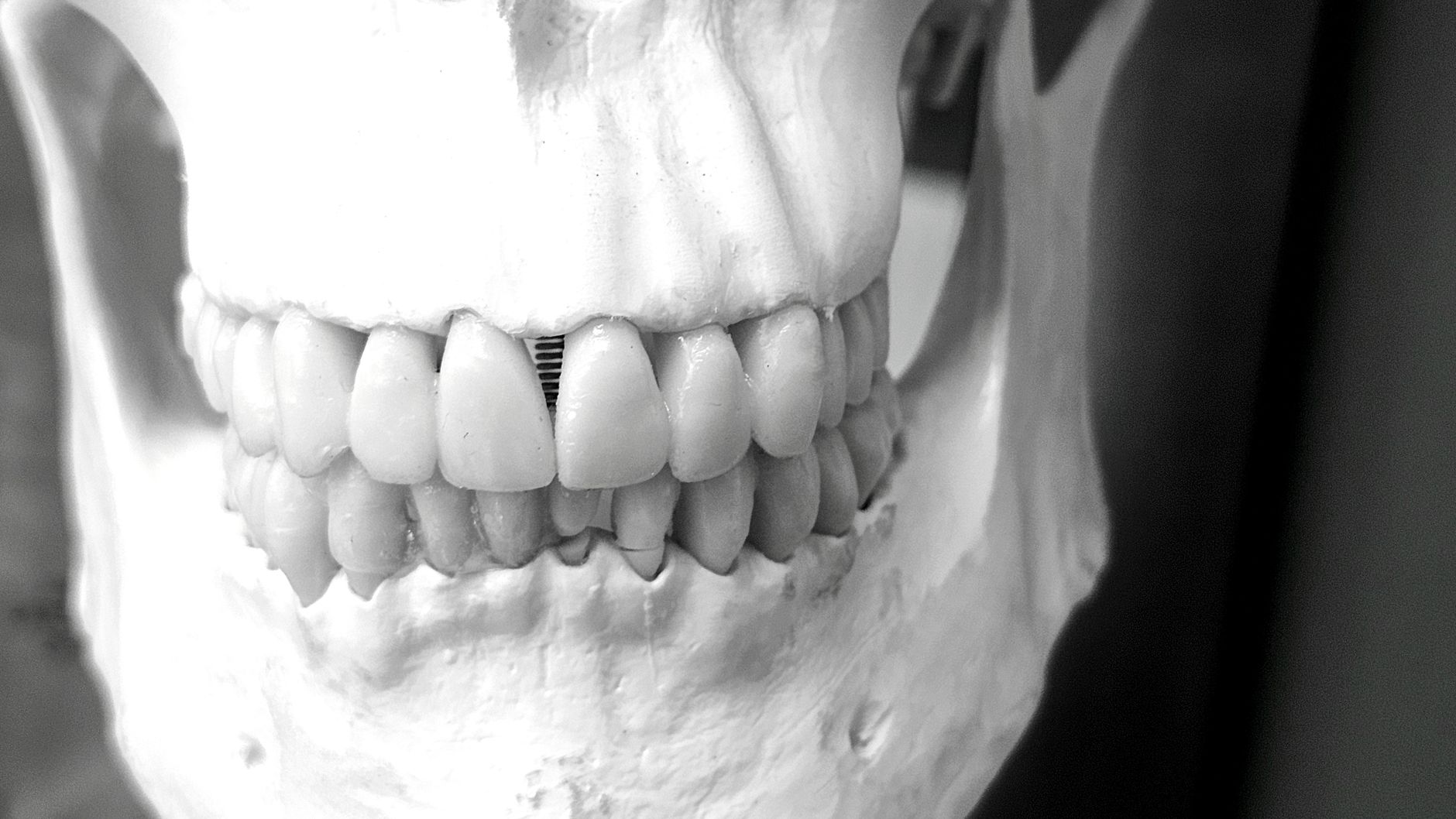 Dental Implants in a Dentistry setting — illustrative photo for Markham, Ontario guide. Dental Implants in a Dentistry setting — illustrative photo for Markham, Ontario guide.