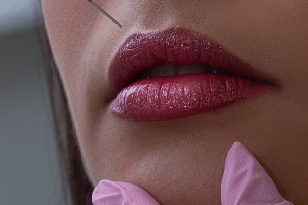 Lip Fillers