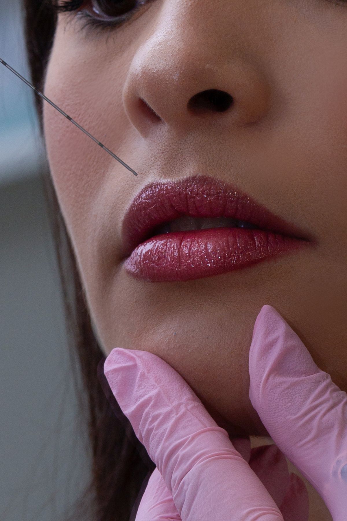 Imagem ilustrativa de procedimento estético nos lábios para Preenchimento Labial