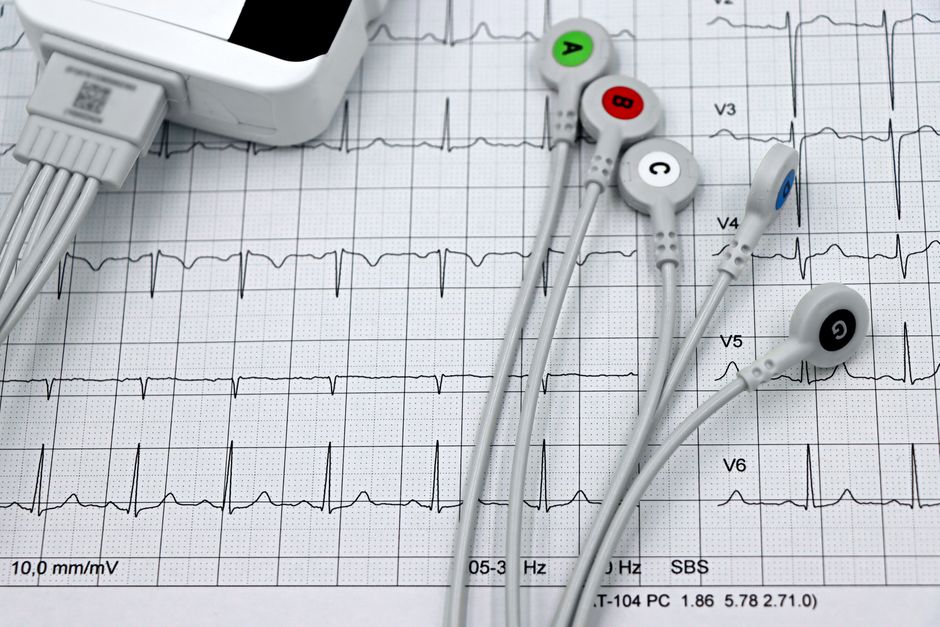 Close-up of ECG leads on a printed cardiac monitor — ibogaine prolongs the QT interval, making EKG screening a mandatory requirement before any iboga ceremony