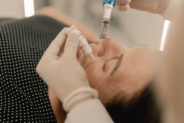 Stretch Mark Treatment