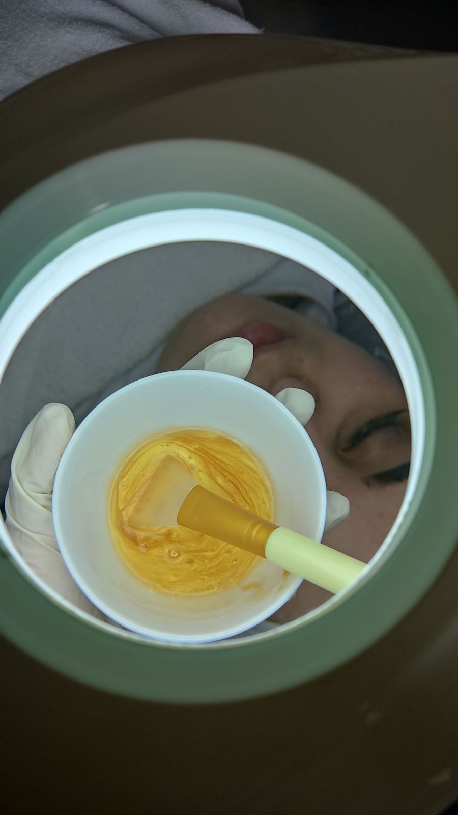 Chemical peel treatment