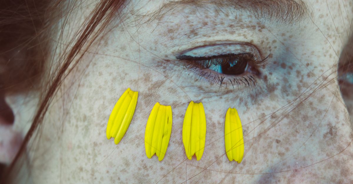 Egyptian Doctor Hossam Mowafi Explains How Liver Spots Appear on the Skin