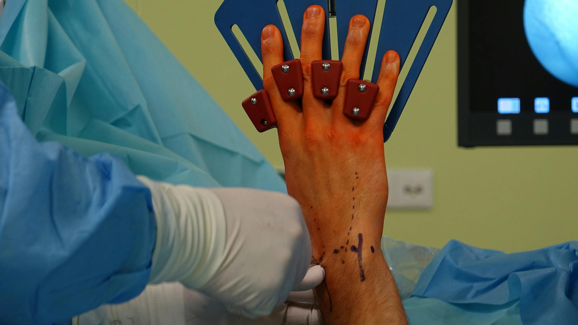 Detail of a hand surgery in an operating room with medical tools.