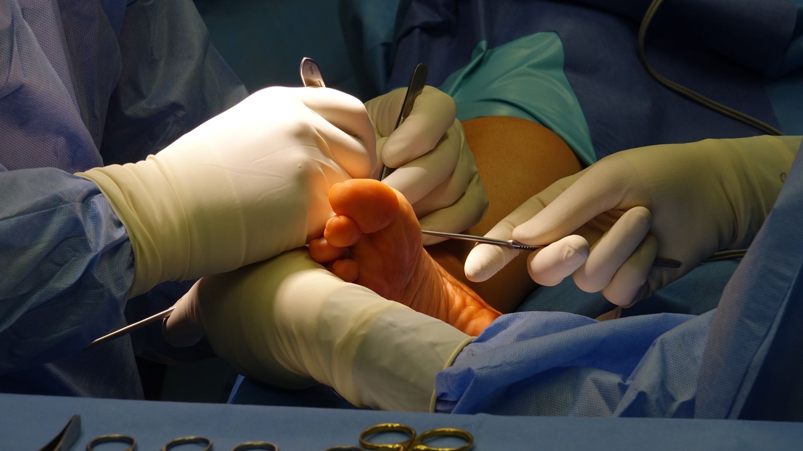 Surgeons performing intricate foot surgery in a sterile operating room environment.