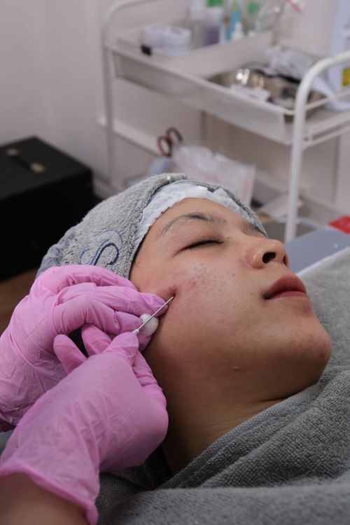 gratis Close-up van een persoon die binnenshuis een microneedling-huidverzorgingsbehandeling ondergaat. Stockfoto